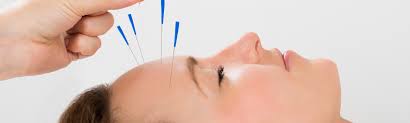 ⁠Treating Migraines and headaches with Acupuncture.