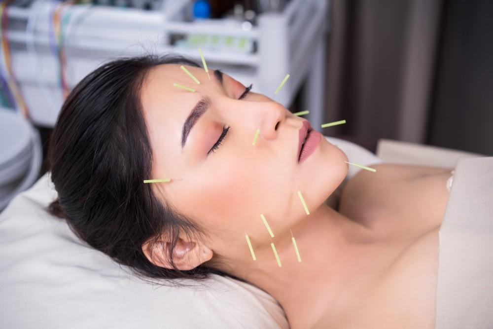 ⁠Treating Migraines and headaches with Acupuncture.